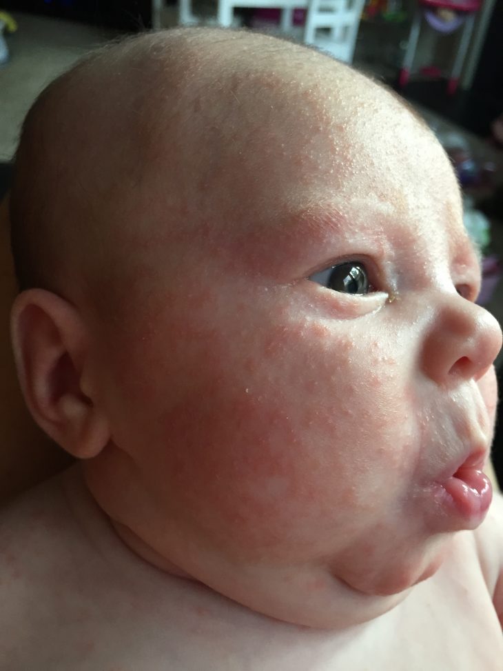 The Truth About Newborn Skin Rashes | Confessions of a Northern Belle